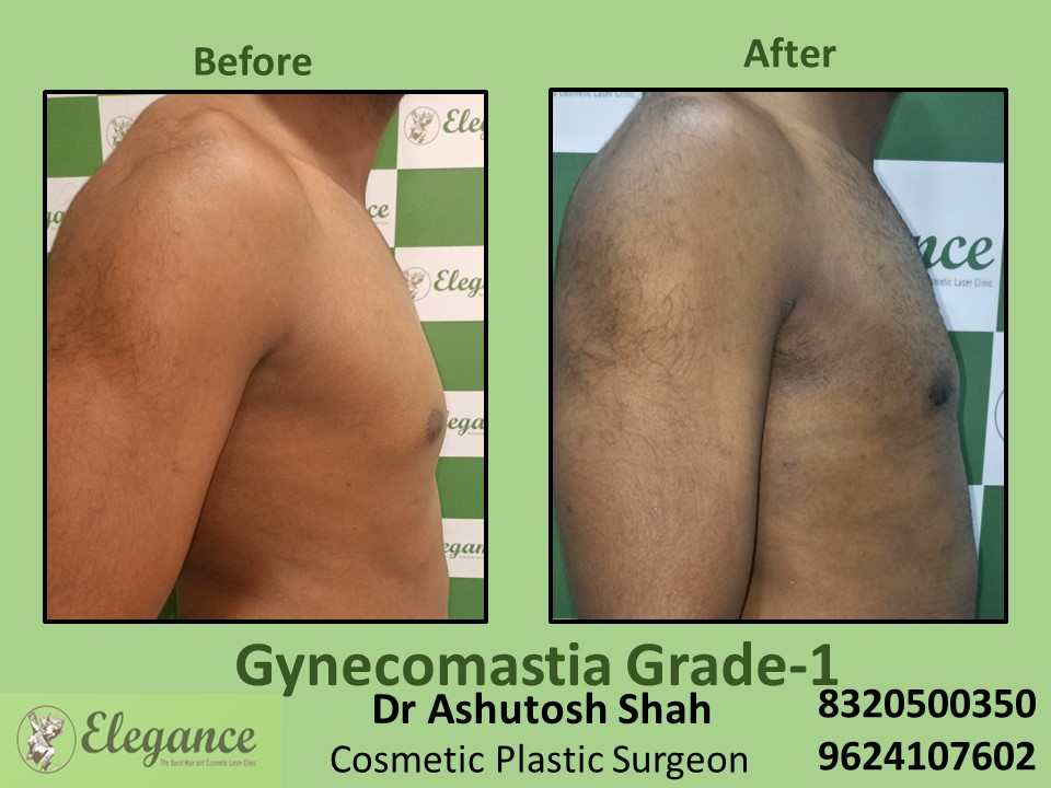 Grade 1 Gynecomastia, Scar Less Keyhole Surgery in Vesu, Piplod Surat