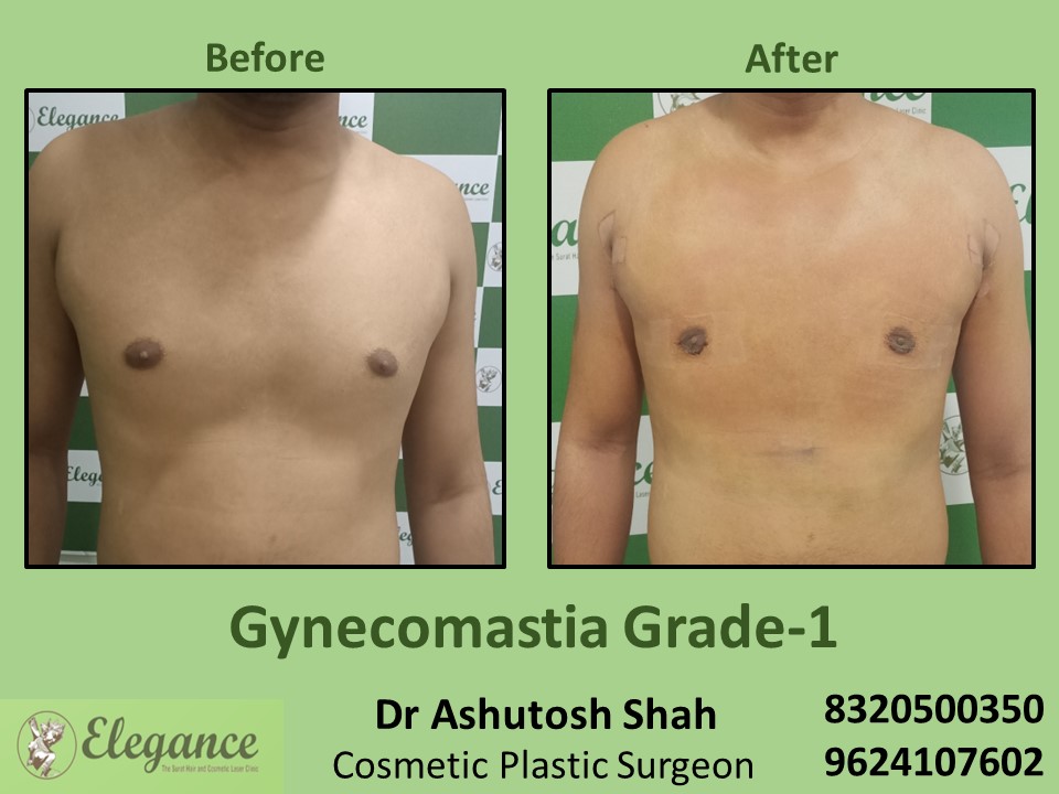 Grade 1 Gynecomastia, Scar Less Keyhole Surgery | Fat Reduction in Vesu, Piplod Surat