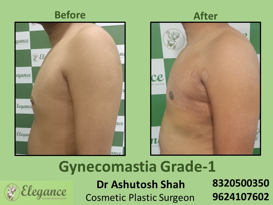 Gynecomastia Grade 1, Best Cosmetic Surgeon in Surat