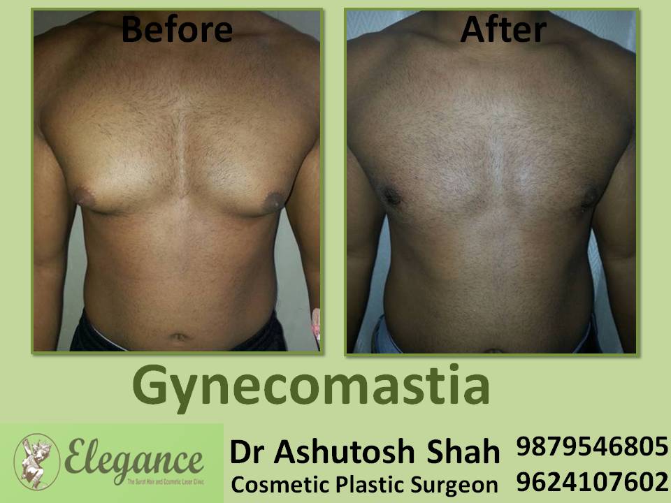 Gynecomestia Surgery In Amritsar, Punjab, India
