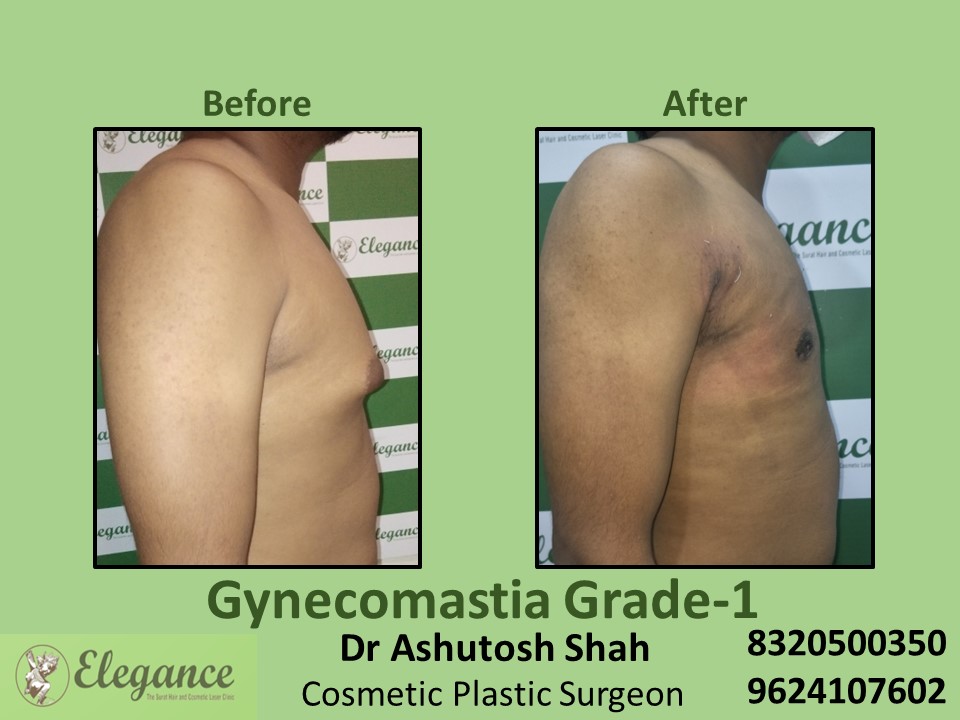 Male Boobs Reduction| Fat Grafting Gynecomastia Grade 1 in Vesu, Surat