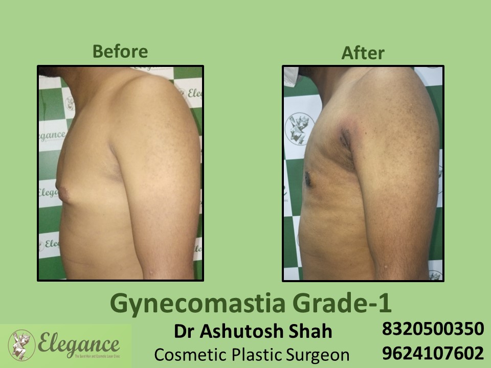 Gynecomastia Grade 1, Best Cosmetic Surgeon in Dumas, Surat