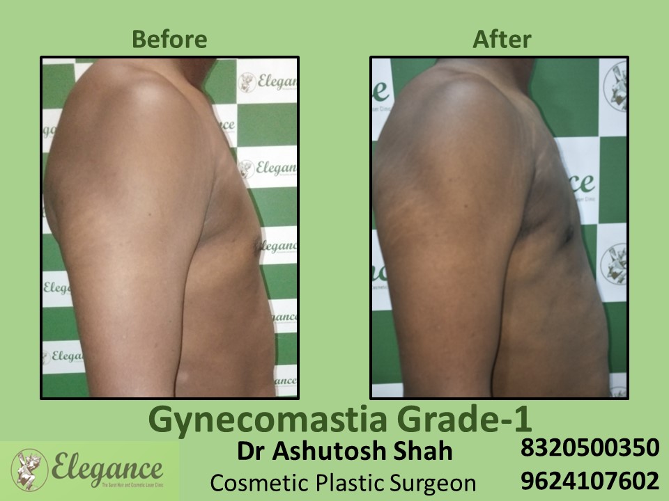 Gynecomastia Grade 1, Best Cosmetic Surgeon in Vesu, Dumas, Surat