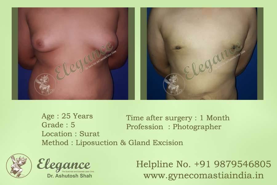 Gynecomestia Surgery In Hyderabad, Telangana, India