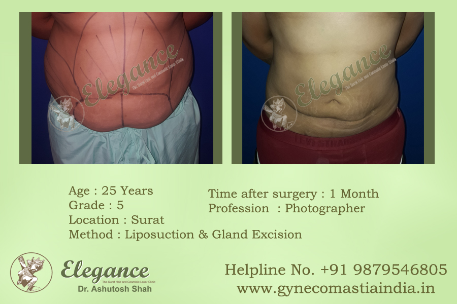 Doctor liposuction In Hyderabad, Telangana, India