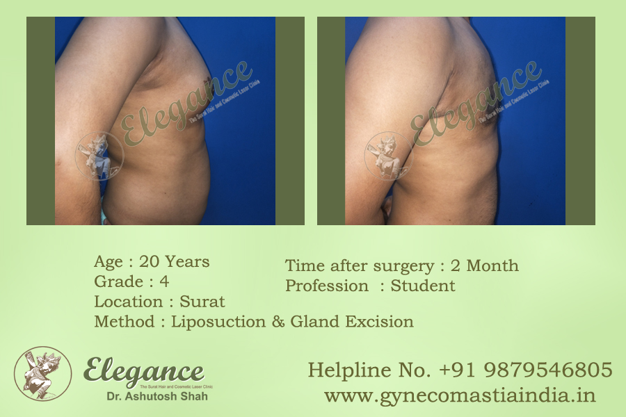 Gynecomestia Surgery Price In Surat, Gujarat, India