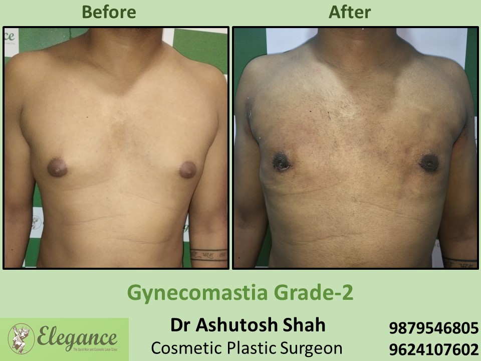 Best Gynecomastia Result in Vesu, Piplod, Surat
