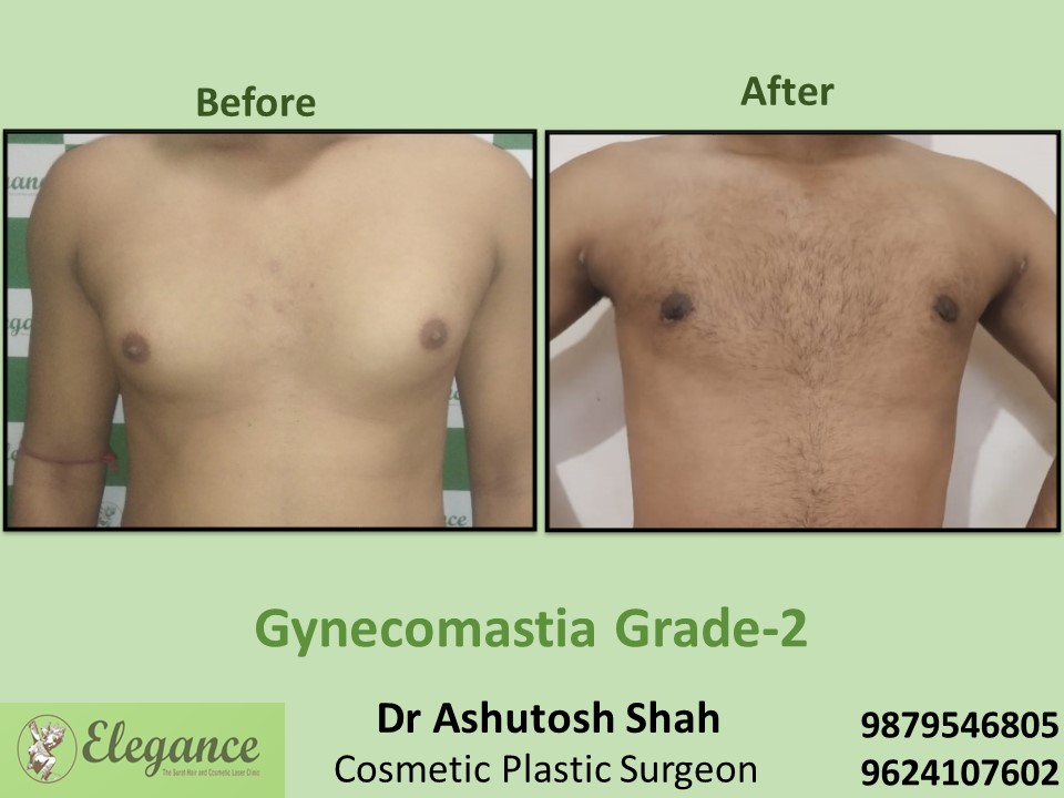 Breast Reduction Surgery from male in Surat, Gujarat