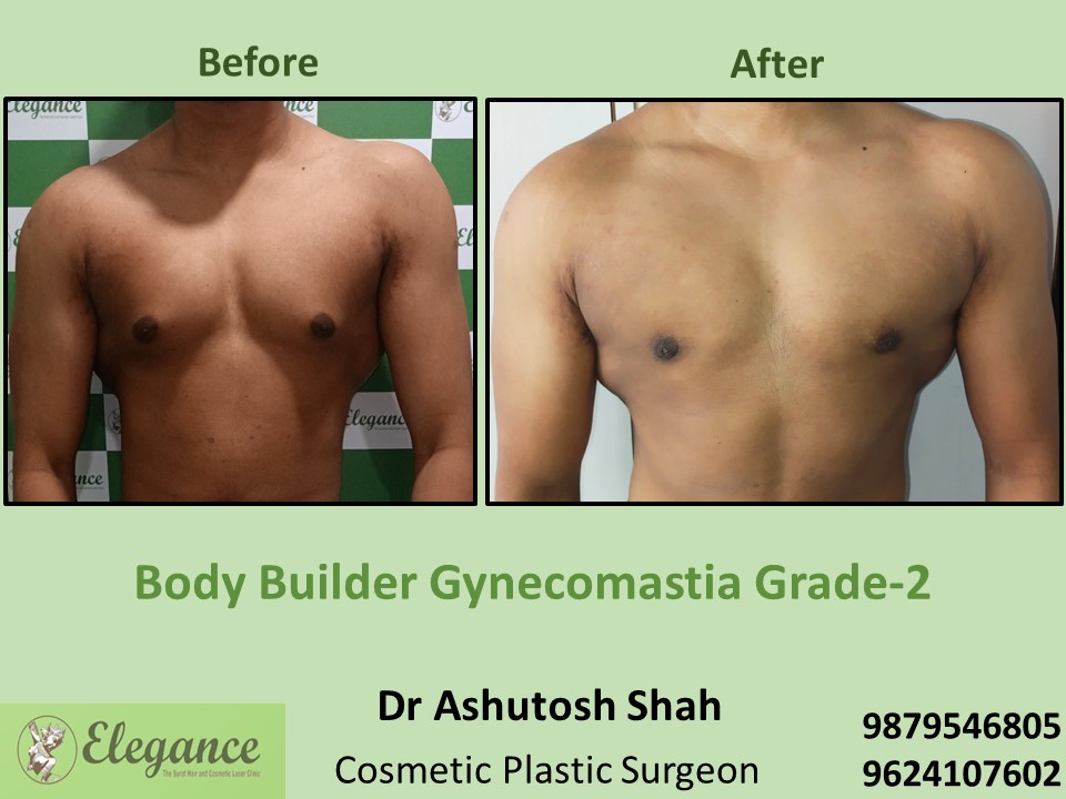 Breast Surgery for Male  in Piplod, Gujarat