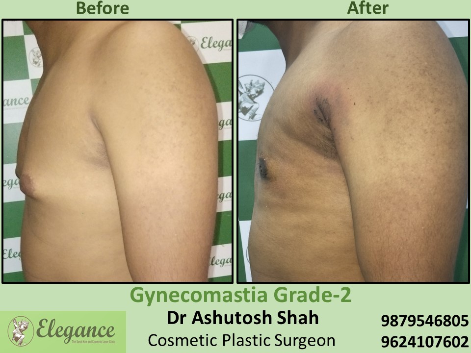 Extra fat reduction in male breast in Varchha, Surat