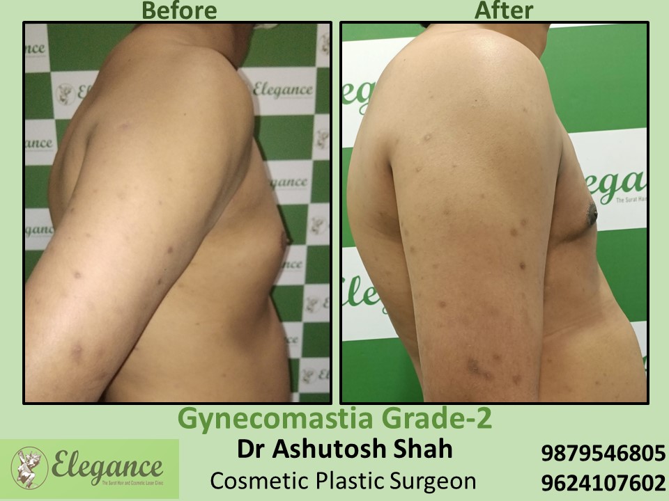 Fat reduction from breast in Ring Road, Surat