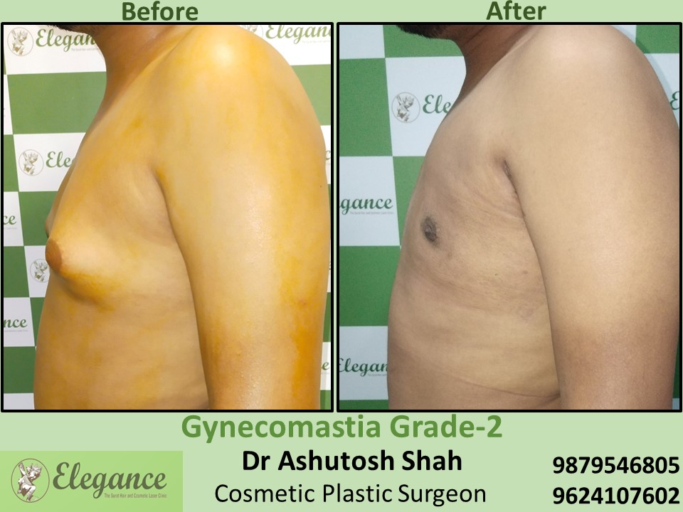 Gynecomastia Surgery in Dumas, Surat, Gujarat