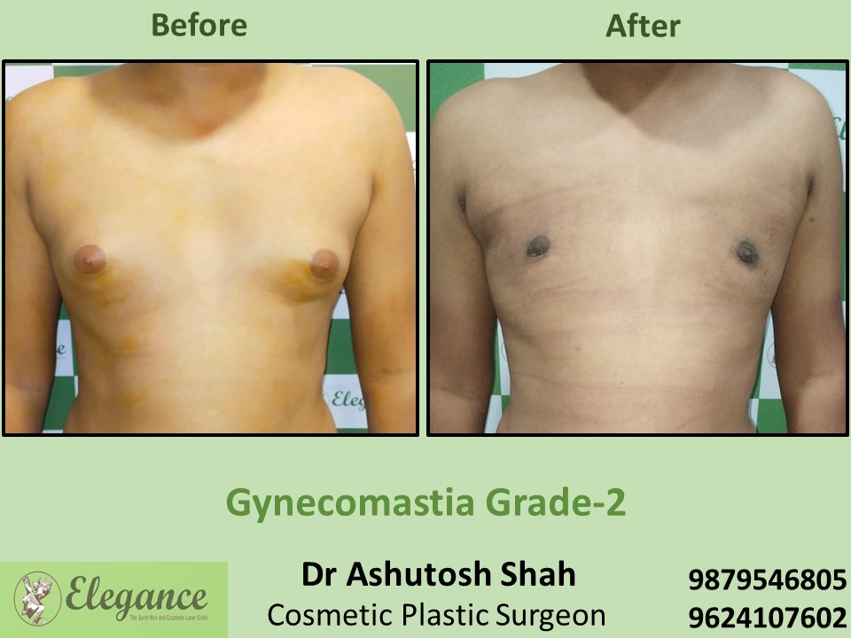 Low cost fat reduction from breast male in Gujarat Gas Circle,  Surat