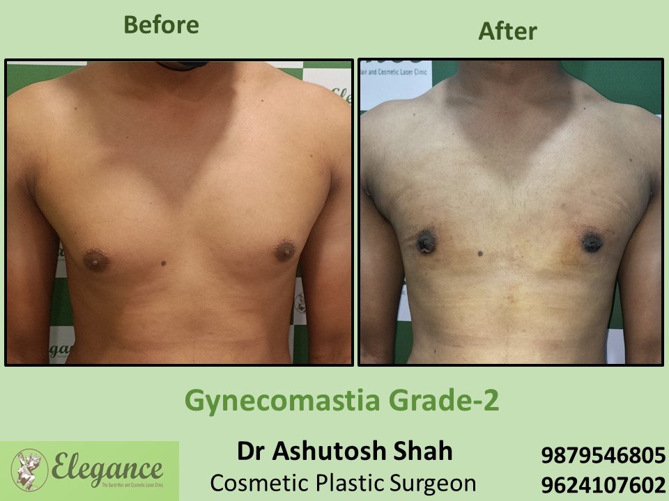 Male breast treatment in VIP Road, Surat