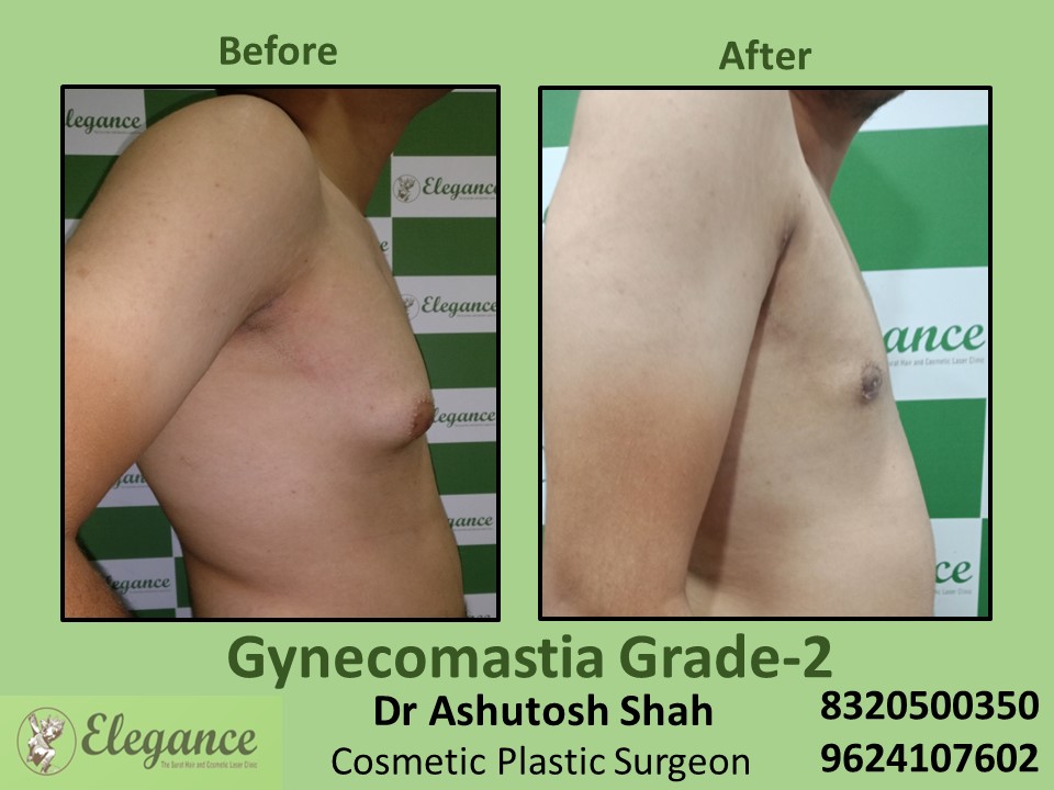 Gynecomastia Grade 2, Fat Surgery, Male Boobs Treatment in Vesu, Surat