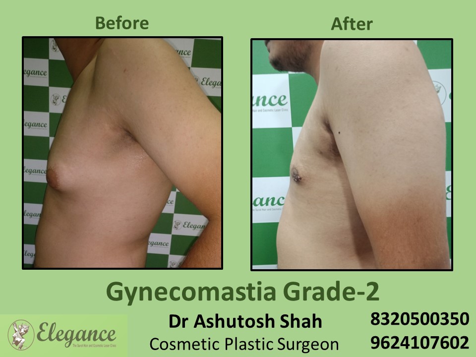 Gynecomastia Grade 2, Fat Surgery, Male Boobs Treatment in Piplod, Surat