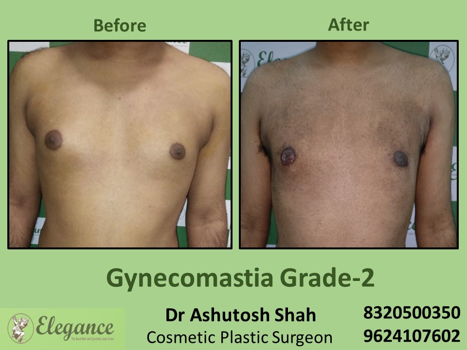 Gynecomastia Grade 2, Fat Surgery, Male Boobs Treatment in Athwagate, Surat