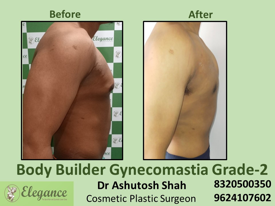 Body Builder Gynecomastia Grade 2, Fat Surgery, Male Boobs Treatment in Udhna, Surat
