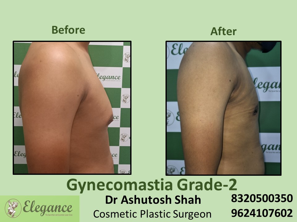 Gynecomastia Grade 2, Male Boobs Reduction Treatment in Nanpura, Parle Point, Surat