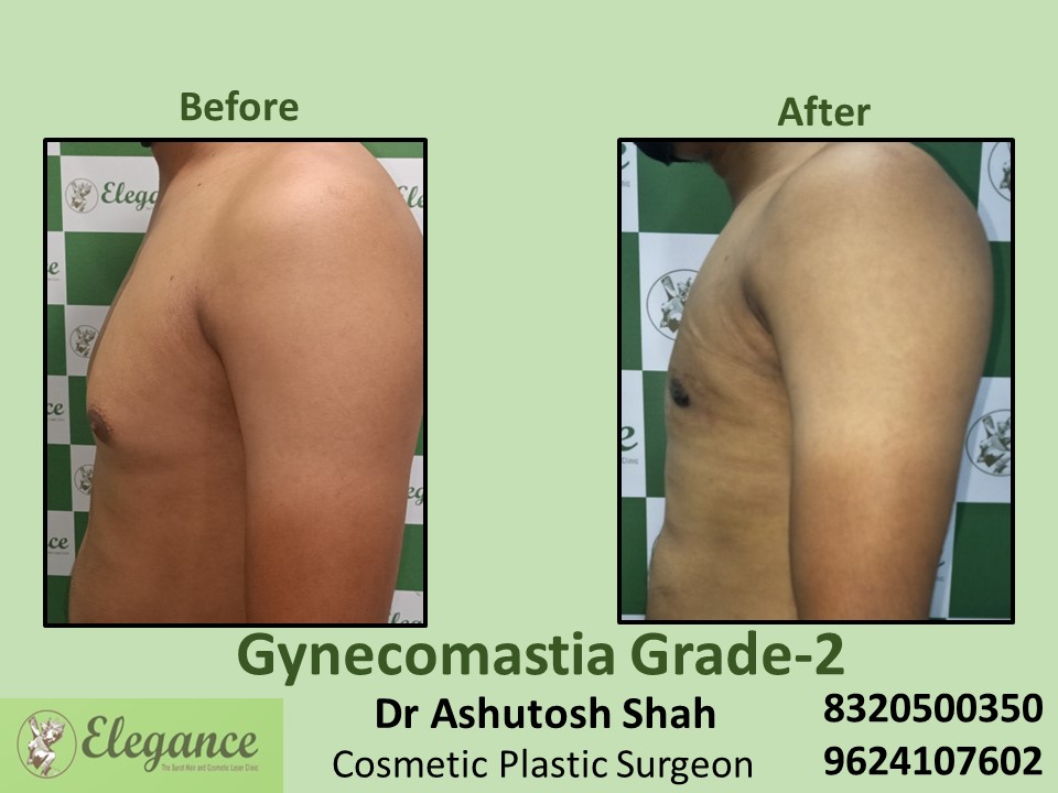 Gynecomastia Grade 2, Male Boobs Reduction Treatment in Nanpura, Surat