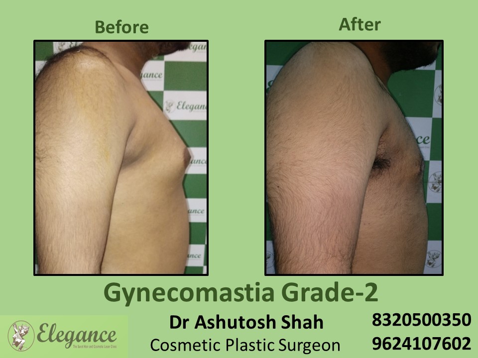 Gynecomastia Grade 2, Fat Reduction, Male Boobs Treatment in Piplod, Udhna, Surat