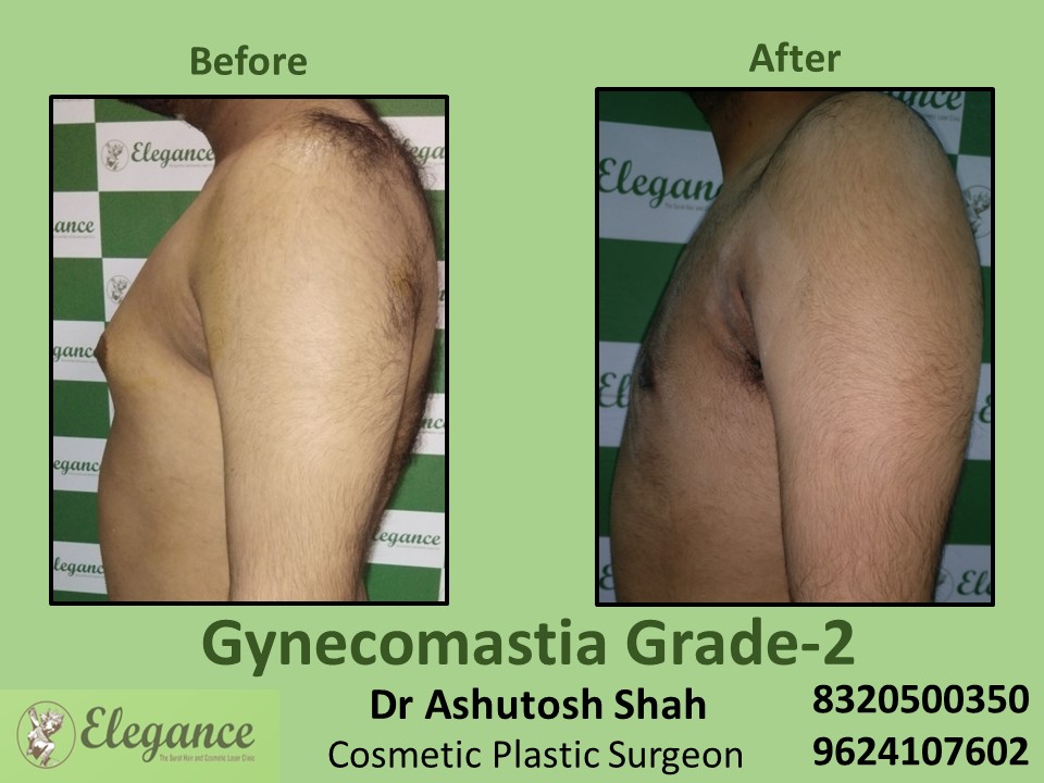 Gynecomastia Grade 2, Male Boobs Reduction Treatment in Majuragate, Surat