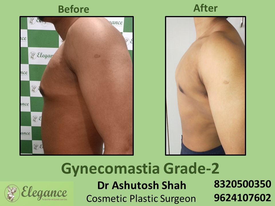 Gynecomastia Grade 2, Fat Reduction, Male Boobs Treatment in Pal, Surat