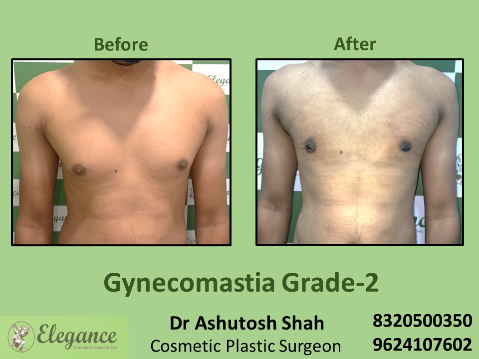 Gynecomastia Grade 2, Fat Reduction, Male Boobs Treatment in Adajan, Pal, Surat