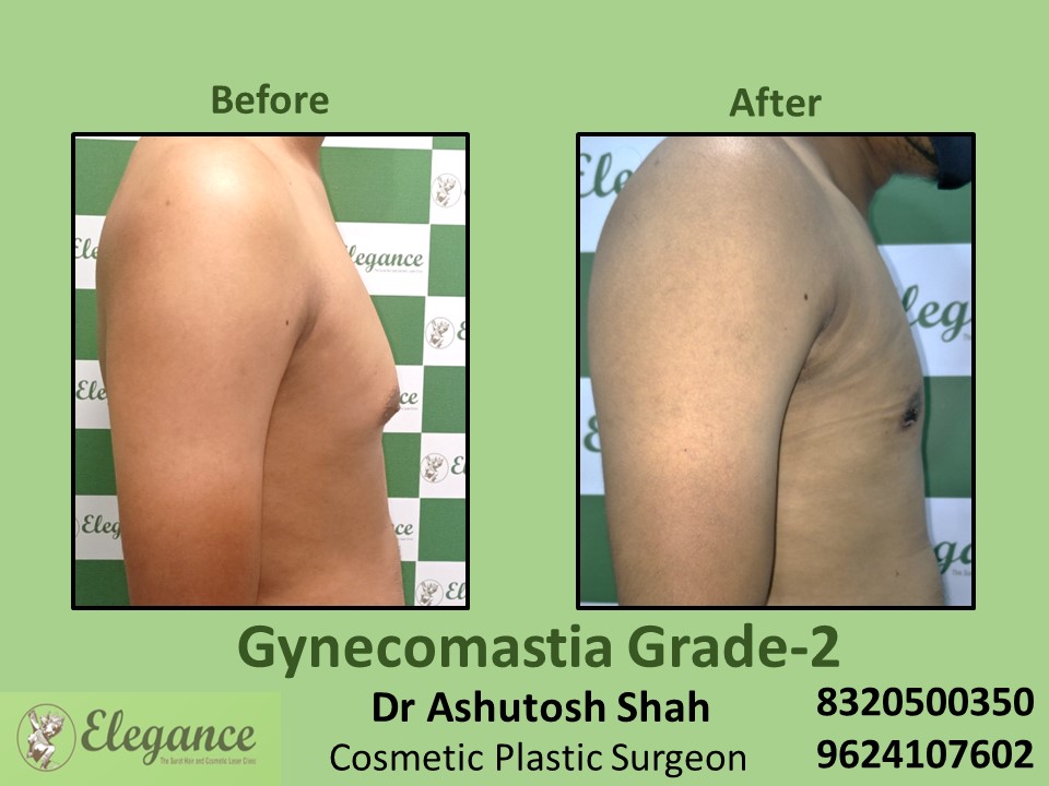 Gynecomastia Grade 2, Male Boobs Treatment in Vesu, Surat