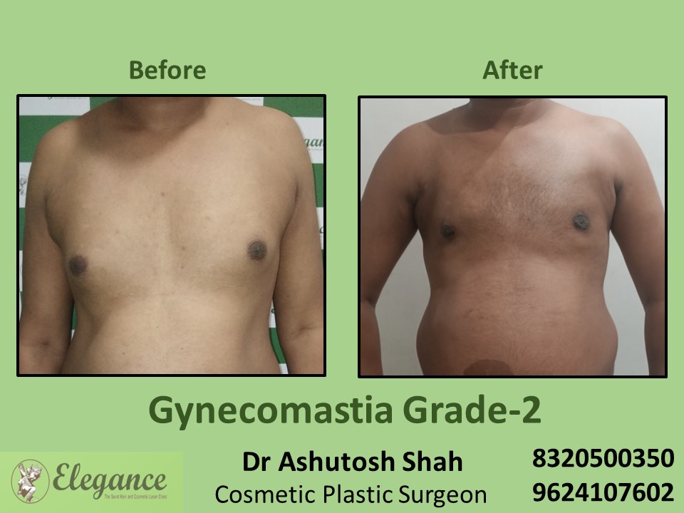 Gynecomastia Grade 2, Male Boobs Treatment in Vesu, Piplod, Surat