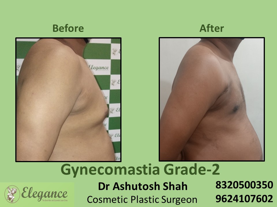 Gynecomastia Grade 2, Male Boobs Treatment in Piplod, Surat