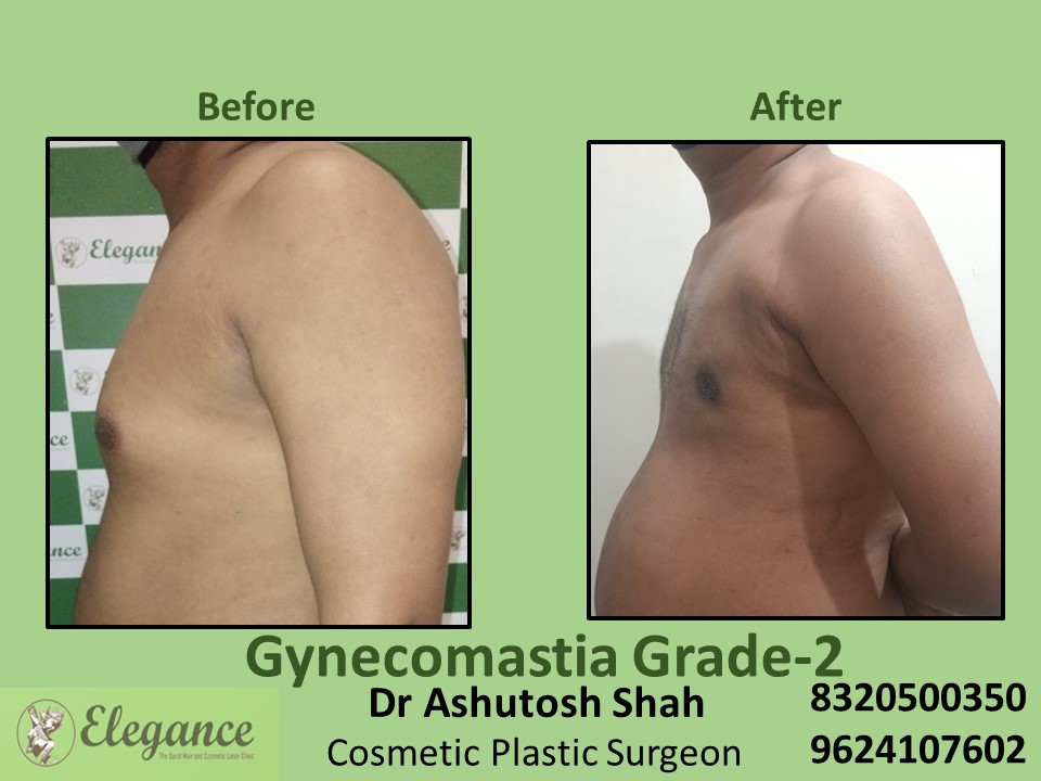 Gynecomastia Grade 2, Male Boobs Treatment in Adajan, Surat
