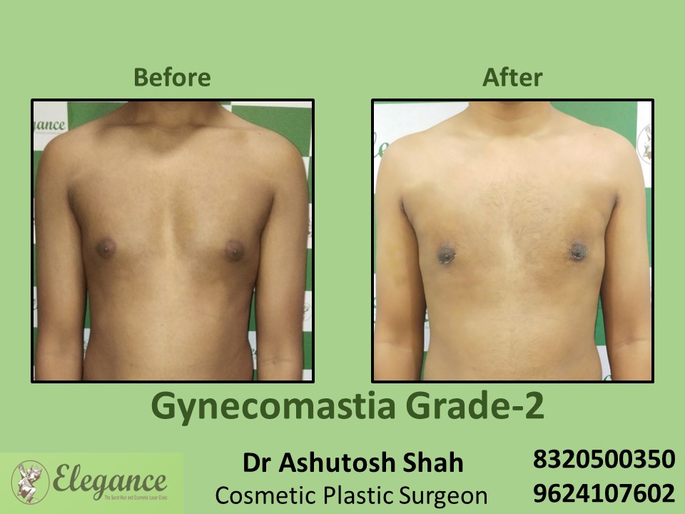 Gynecomastia Grade 2, Fat Reduction, Male Boobs Treatment in Adajan, Surat