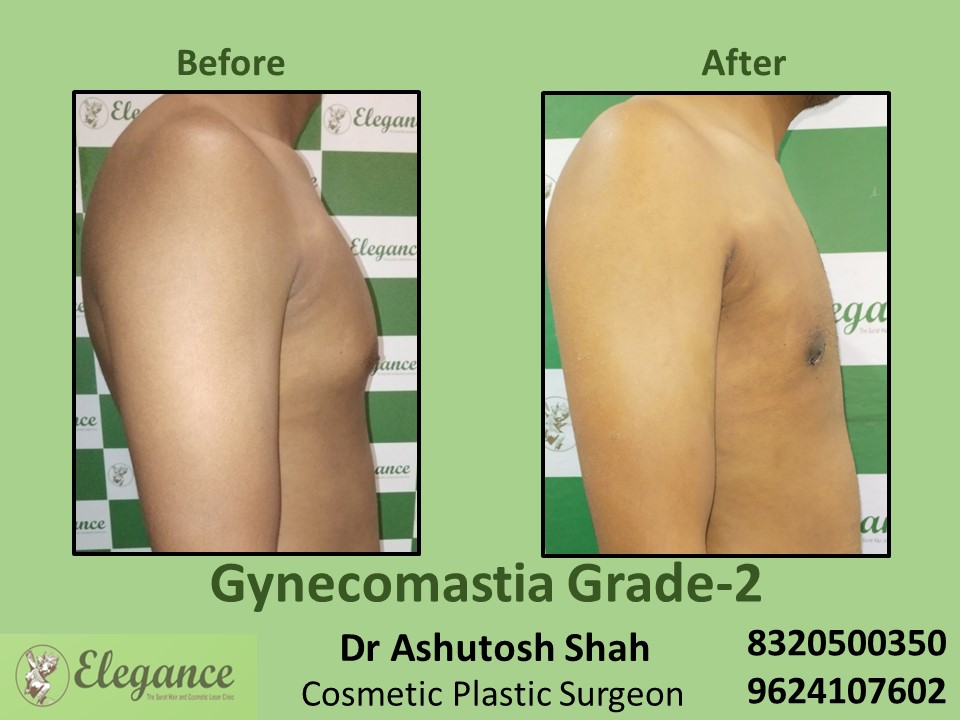 Gynecomastia Grade 2, Fat Surgeon, Male Boobs Treatment in Athwagate, Piplod, Surat