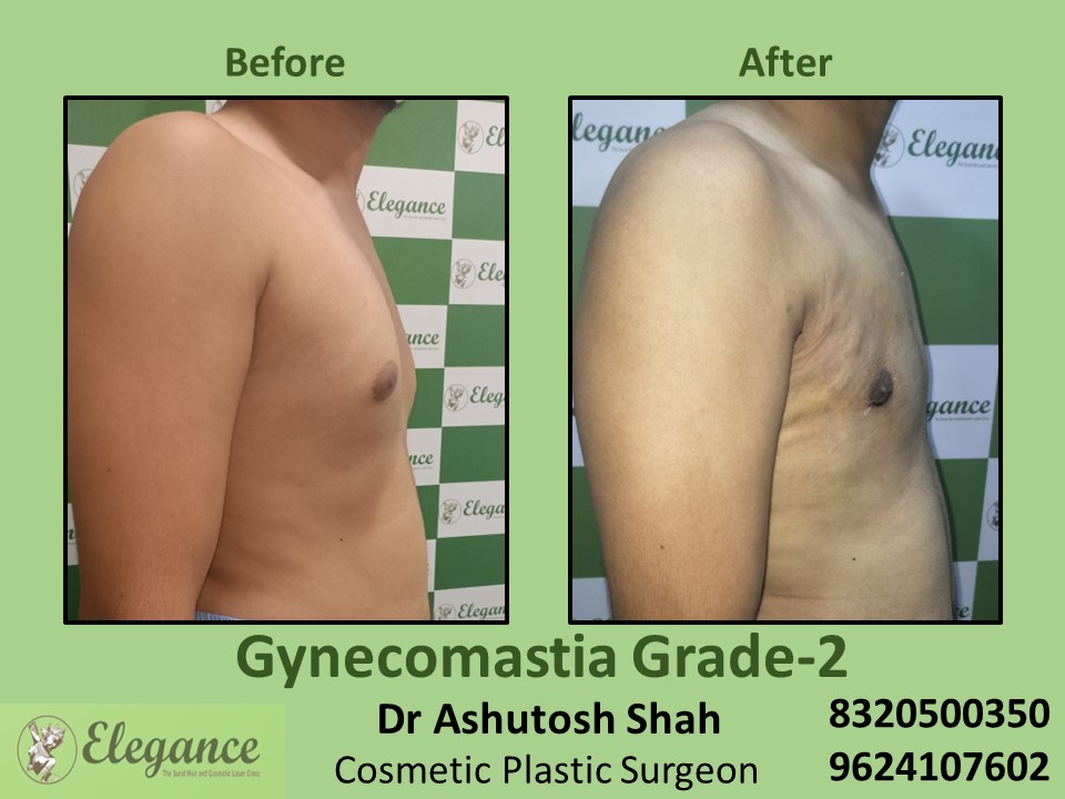 Gynecomastia Grade 2, Fat Surgeon, Male Boobs Treatment in Piplod, Surat