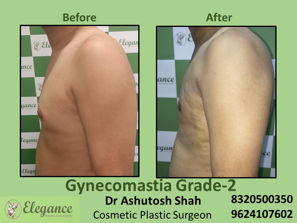 Gynecomastia Grade 2, Fat Surgeon, Male Boobs Treatment in Surat