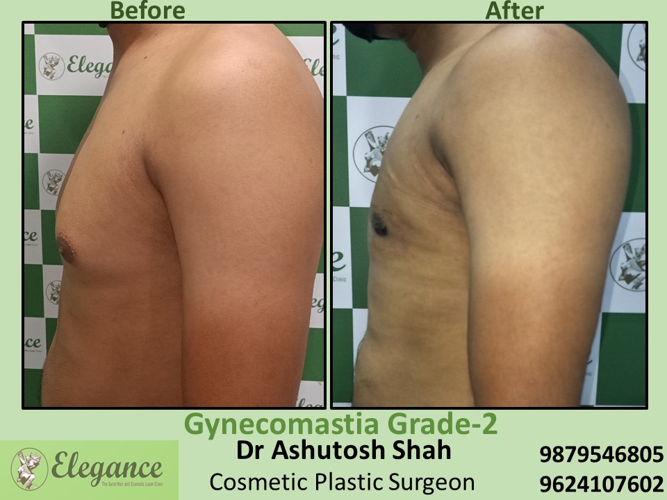 Surgery for male breast reduction in Athwagate, Surat