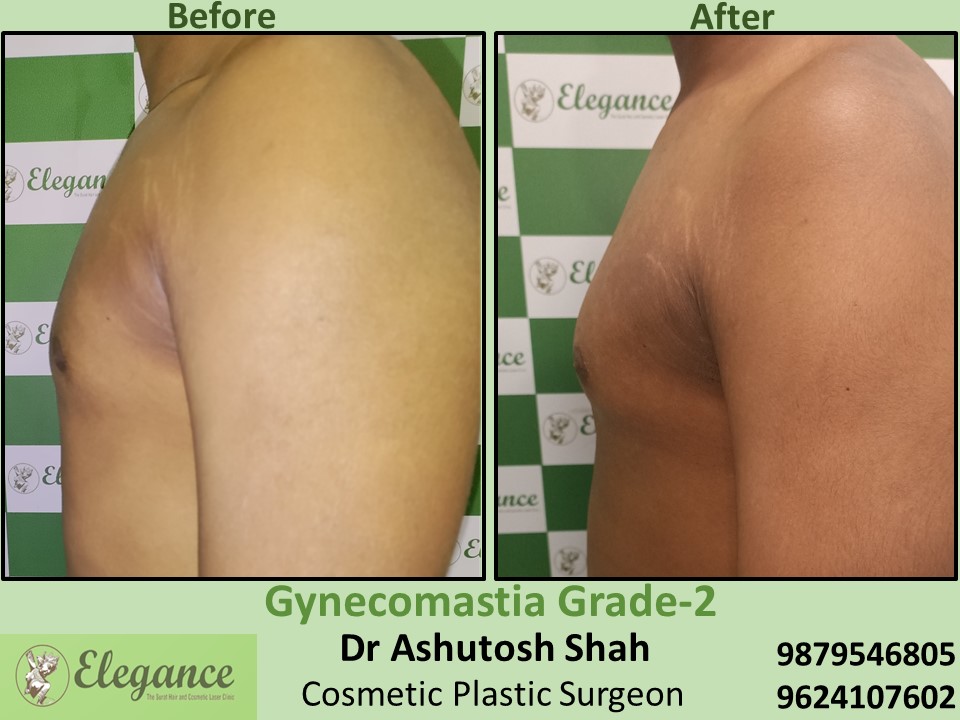 Treatment of gynecomastia in Vesu, Athwagate, Surat