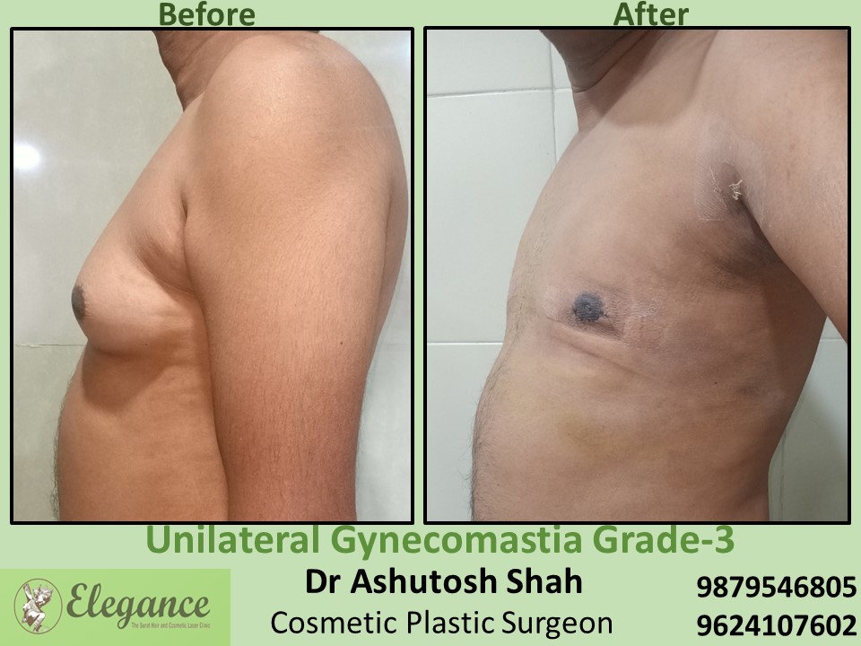 Affordable price for big breast in male surgery in Athwagate, Surat