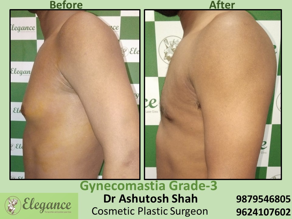 Affordable treatment for big breast in male at lal darwaja, Surat
