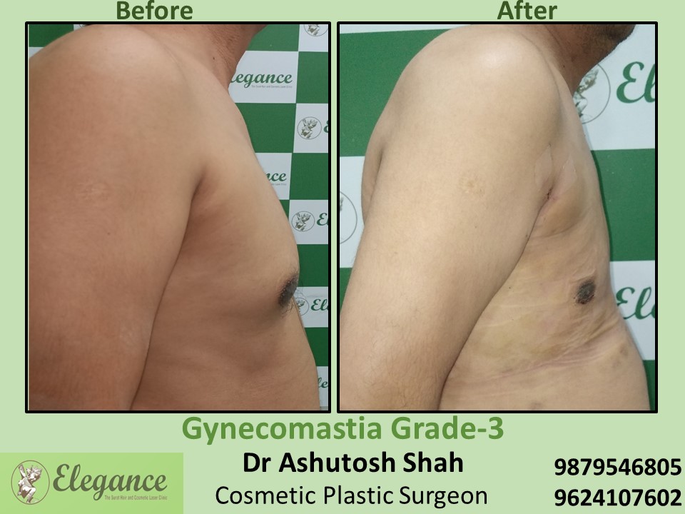 Best Clinic for Gynecomastia in Surat