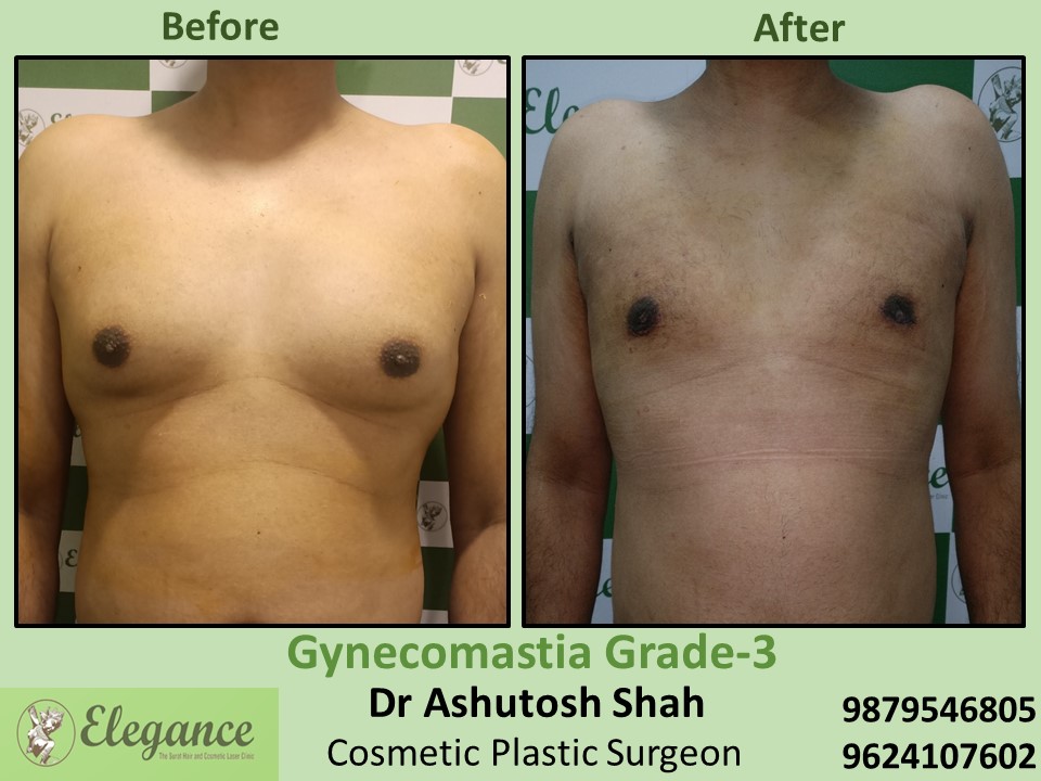 Best Gynecomastia Surgery in Surat