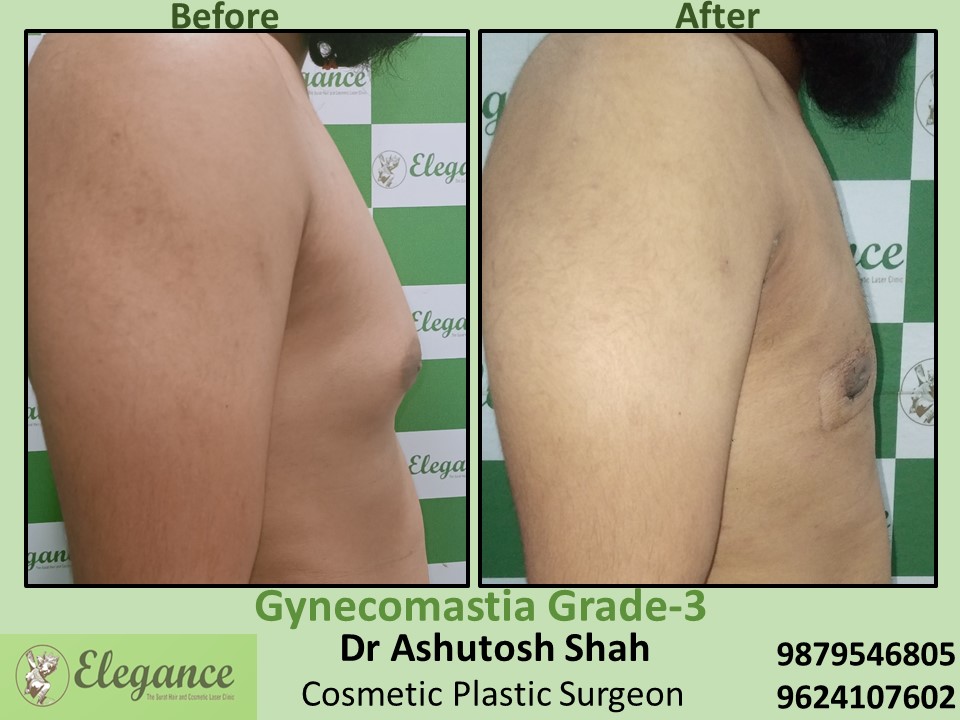 Best Surgery and Painless Treatment in Surat
