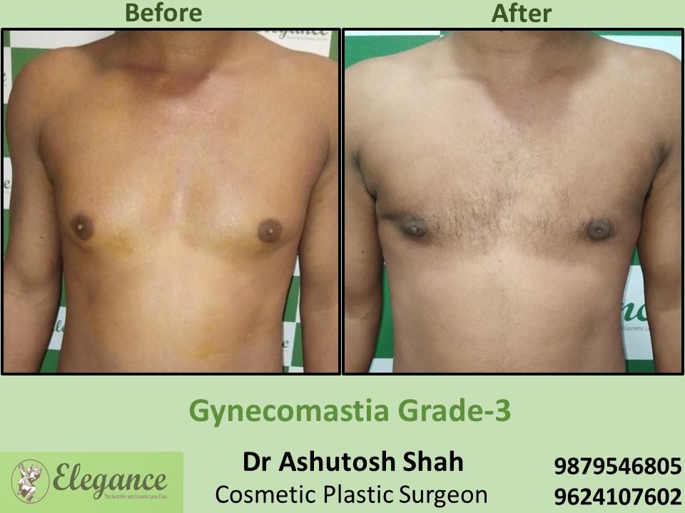 Best Treatment for Extra Big Breast in Male in Surat