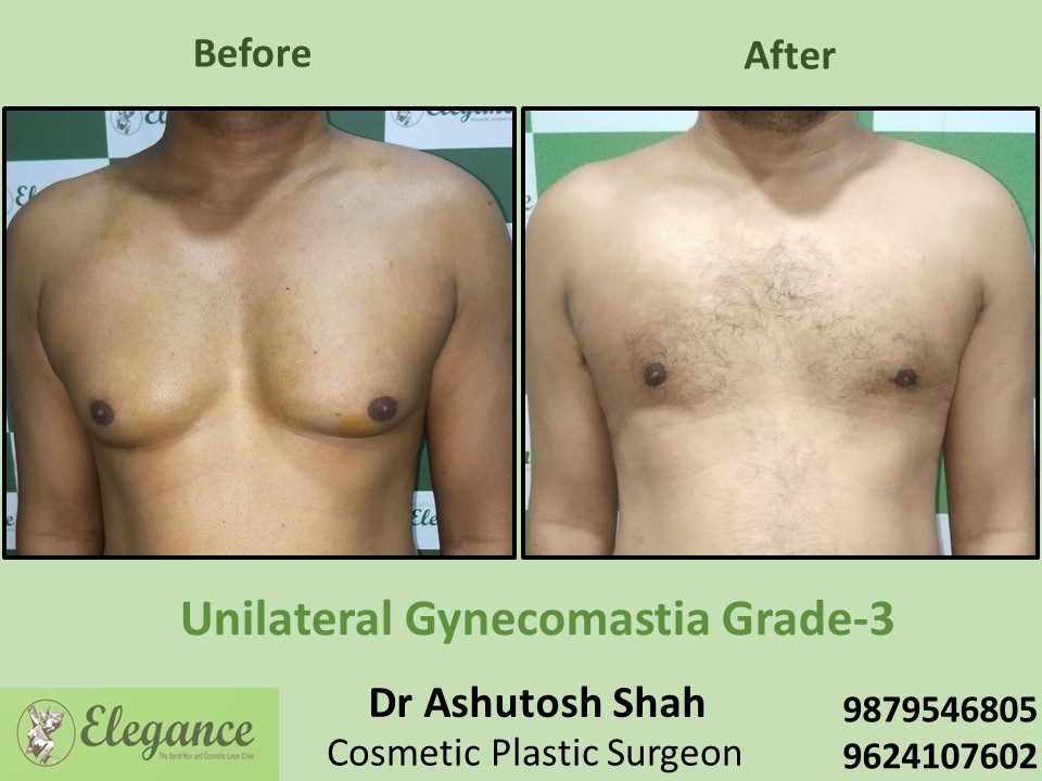 Extra fat reduction in male breast in Udhna, Surat