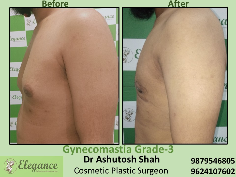 Fat Reduction from Breast of Male in Majura gate, Surat