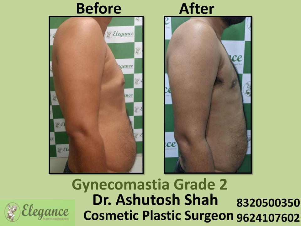 Grade2 - Male Chest Fat Accumalation, Surgery For Gynecomastia, Bharuch, Bilimora, Bardoli, Surat, Gujarat.