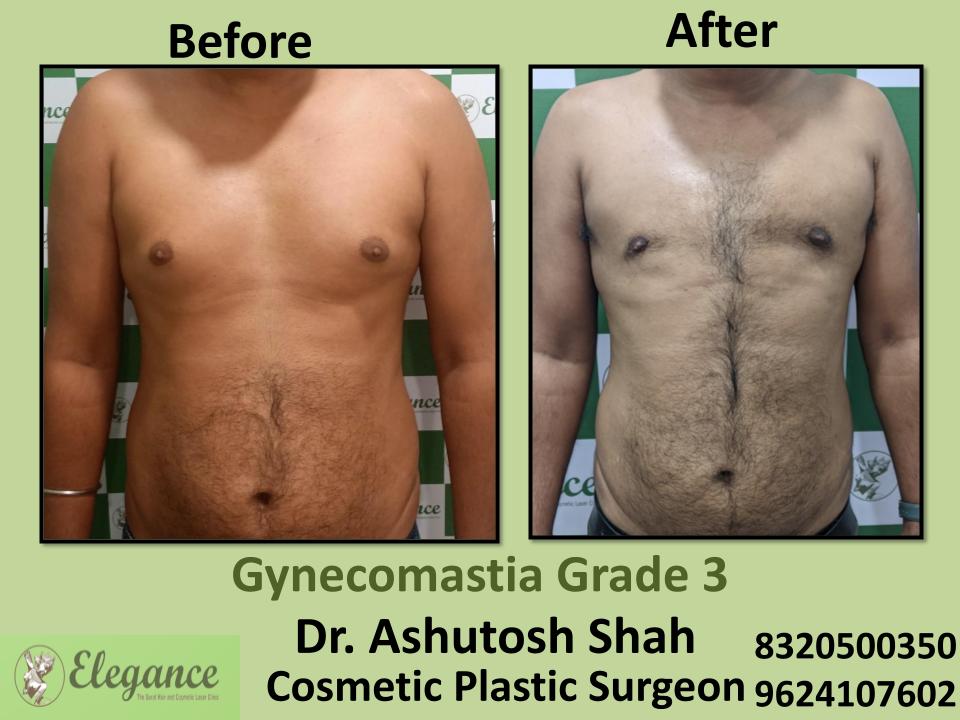 Grade3 - Hormonal Imbalance, Surgery For Gynecomastia, Best Surgeons, Piplod, Vesu, Citylight, Surat, Gujarat.