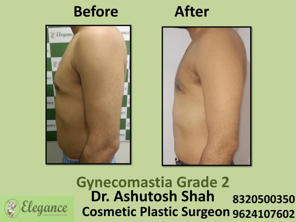 Gyencomastia Grade 2, Enlarged Chest In Males, Umra, Athwalines, Piplod, Vesu, Surat, Gujarat.