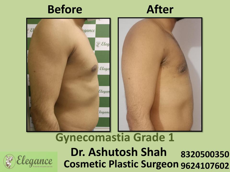 Gyencomastia Grade 1, Excessive Male Breast Tissue, Nanavaraccha, Dinndoli, Pandesara, Surat, Gujarat.